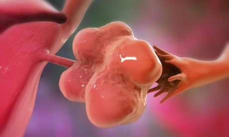 Σύνδρομο πολυκυστικών ωοθηκών: Νέο χάπι μειώνει την τεστοστερόνη και βοηθά στη γονιμότητα