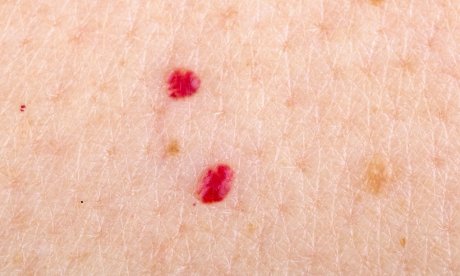 Κόκκινες ελιές στο δέρμα: Τι πρέπει να αποφεύγετε