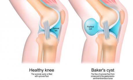 Πόνος πίσω από το γόνατο: Τι είναι η κύστη Baker