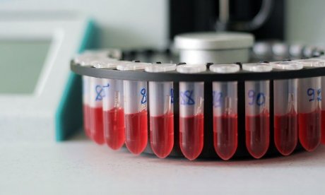 Έγκαιρη ανίχνευση λευχαιμίας: Σωστή ερμηνεία 5 συμπτωμάτων καρκίνου στο αίμα
