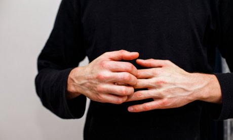 Εξάνθημα Χασιμότο: Πώς μοιάζει το σημάδι θυρεοειδίτιδας στο δέρμα