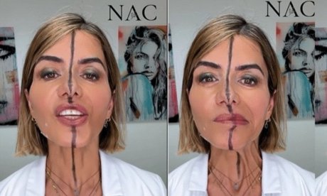 Η γιατρός που έκανε botox μόνο στο μισό της πρόσωπο για να δείξει τις αληθινές επιδράσεις του