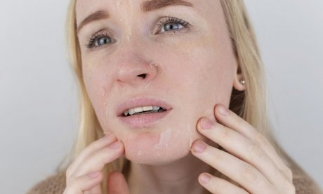 Μήπως βγάλατε το “εξάνθημα του χειμώνα” τώρα που κρύωσε ο καιρός;