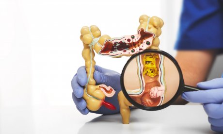 Κάθε πότε πρέπει να κάνετε κολονοσκόπηση ανά ηλικία και επίπεδο κινδύνου