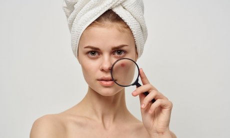 Πώς να αφαιρέσετε τα μαύρα στίγματα για να μην μείνουν σημάδια