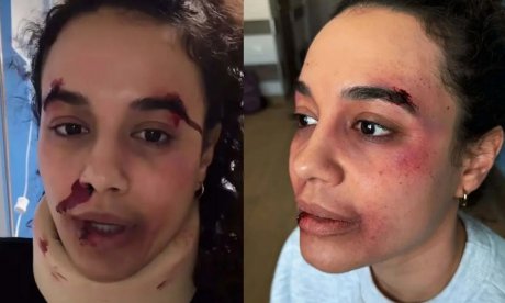 Η Πηνελόπη Πλάκα με αμυχές στο πρόσωπο, μώλωπες, αίματα & επιδέσμους: «Πήρα τη μαμά μου...»